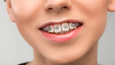 Niềng răng - Chỉnh nha Thẩm mỹ
