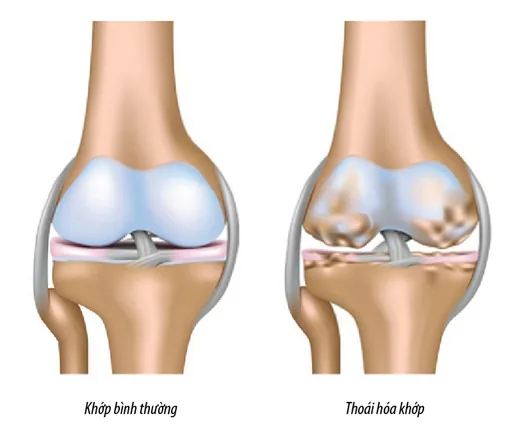 Tổng quan về thoái hóa khớp gối - Bệnh viện SANTE Bình Thạnh, TP.HCM Tổng quan về thoái hóa khớp gối - Bệnh viện SANTE Bình Thạnh, TP.HCM