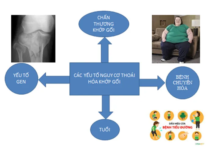 Tổng quan về thoái hóa khớp gối - Hình 2 - Bệnh viện SANTE Bình Thạnh, TP.HCM Tổng quan về thoái hóa khớp gối - Hình 2 - Bệnh viện SANTE Bình Thạnh, TP.HCM