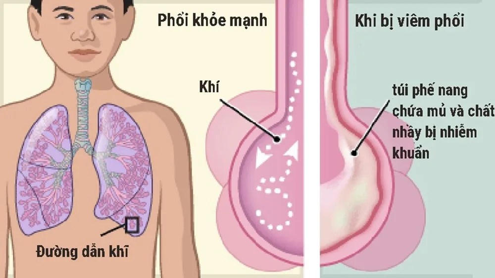 Viêm đường hô hấp cấp ở trẻ em - Bệnh viện SANTE Bình Thạnh, TP.HCM