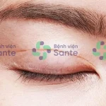 Bệnh viện phẫu thuật chỉnh hình cắt mí mắt tại TPHCM ở đâu tốt nhất