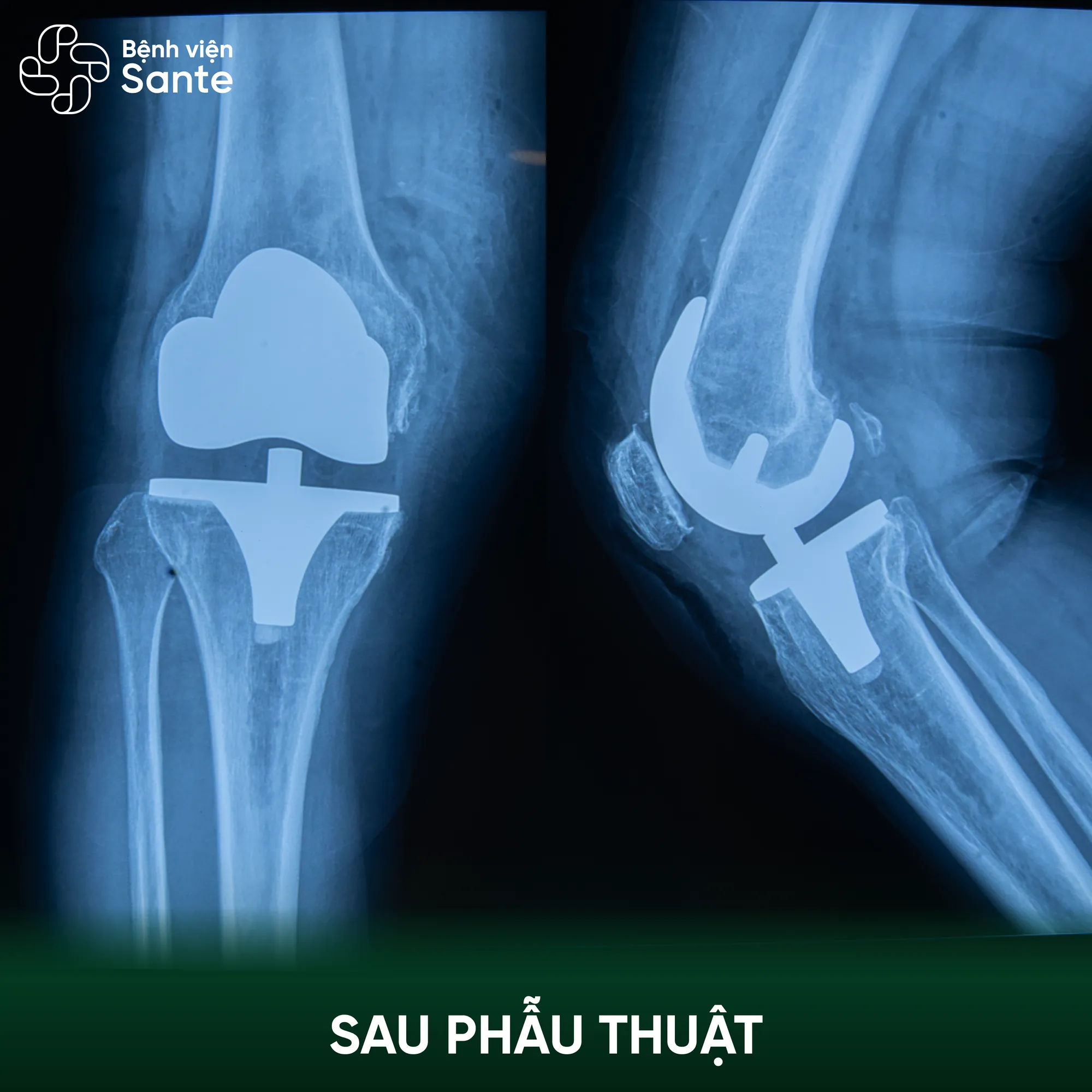 Bệnh viện Sante - Hơn 30 năm đau khớp gối, bệnh nhân 60 tuổi xuất viện sau 24 giờ thay khớp tại Sante (Hình 3) Postoperative radiograph following total knee arthroplasty at Sante Hospital