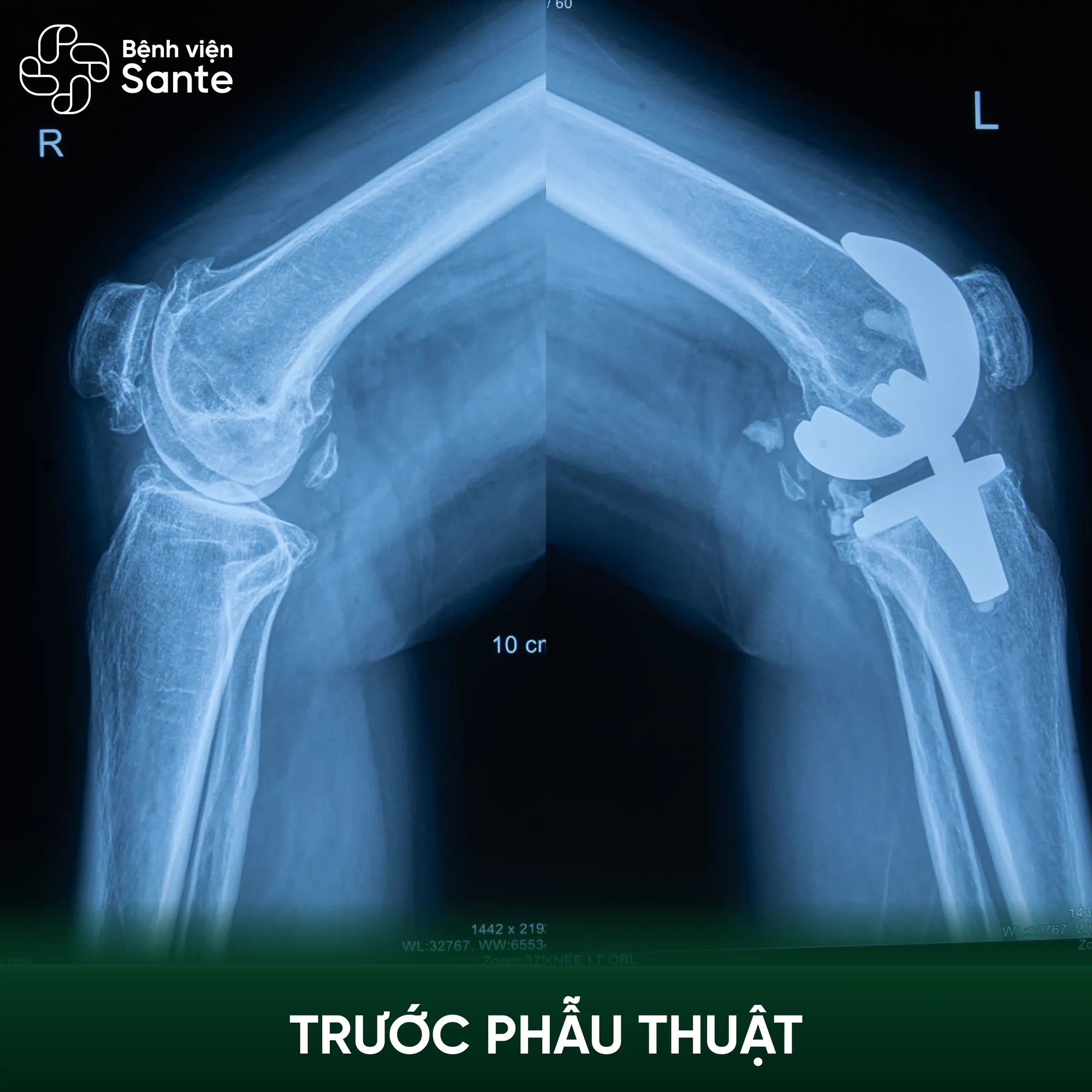 Bệnh viện Sante - Hơn 30 năm đau khớp gối, bệnh nhân 60 tuổi xuất viện sau 24 giờ thay khớp tại Sante Preoperative bilateral knee X-ray of patient Huong demonstrating advanced osteoarthritis at Sante Hospital