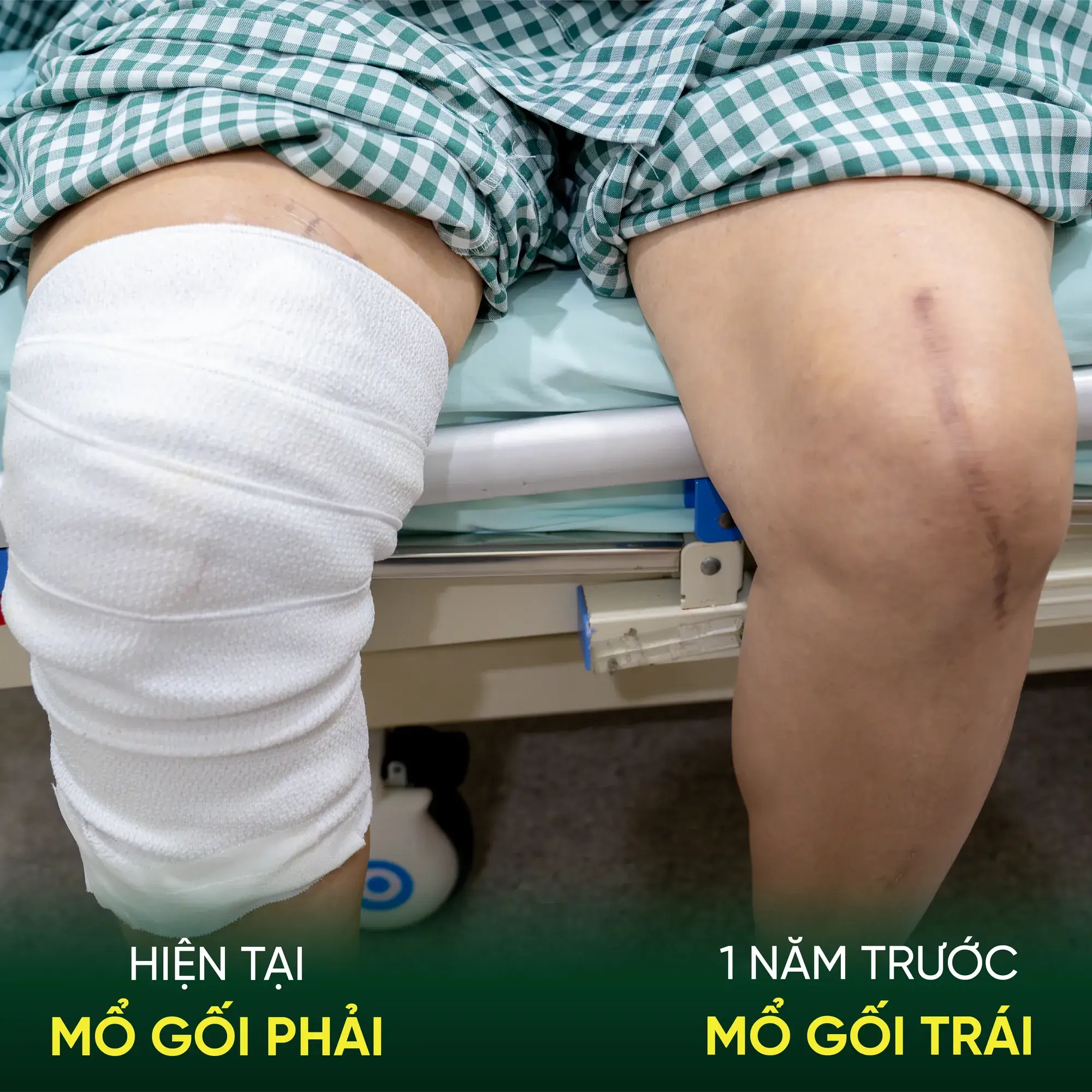 Bệnh viện Sante - Hơn 30 năm đau khớp gối, bệnh nhân 60 tuổi xuất viện sau 24 giờ thay khớp tại Sante (Hình 2) Comparative assessment of bilateral knee recovery outcomes for patient Huong at Sante Hospital
