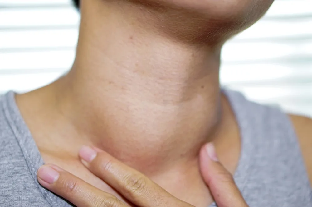 Bướu cổ nguyên nhân và cách phòng tránh 1 - Bệnh viện SANTE Bình Thạnh, TP.HCM