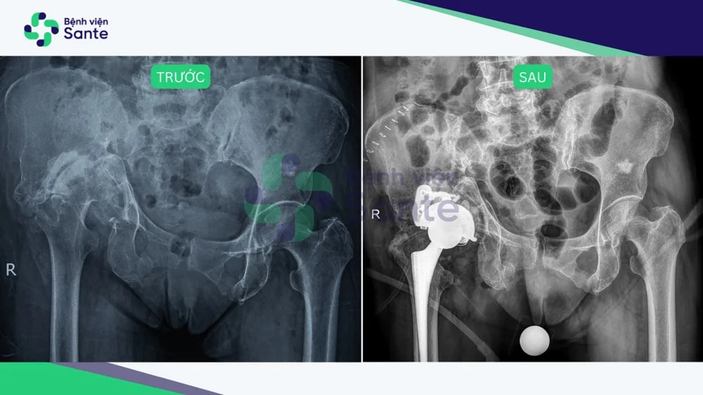 Giải thoát “chân thấp chân cao” sau 50 năm chịu đựng - Hình 2 - Bệnh viện SANTE Bình Thạnh, TP.HCM Giải thoát “chân thấp chân cao” sau 50 năm chịu đựng - Hình 2 - Bệnh viện SANTE Bình Thạnh, TP.HCM