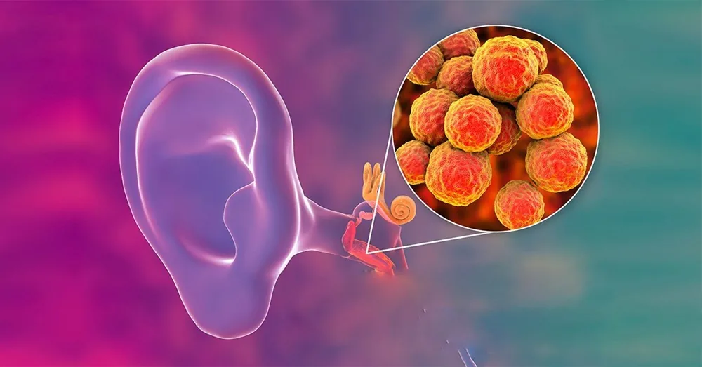 Hiểu rõ và phòng ngừa bệnh viêm tai giữa - Hình 2 - Bệnh viện SANTE Bình Thạnh, TP.HCM