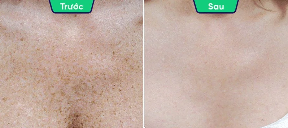 Điều trị da: nám, tàn nhang, mụn, nâng cơ trẻ hóa da và triệt lông