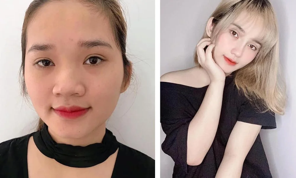 Bệnh viện Sante - Phẫu thuật thẩm mỹ thay đổi hoàn toàn gương mặt (Hình 3)