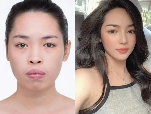 Bệnh viện Sante - Phẫu thuật thẩm mỹ thay đổi hoàn toàn gương mặt (Hình 5)