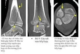 CT scan gãy đầu dưới xương chày CT scan gãy đầu dưới xương chày - Bệnh viện SANTE Bình Thạnh, TP.HCM