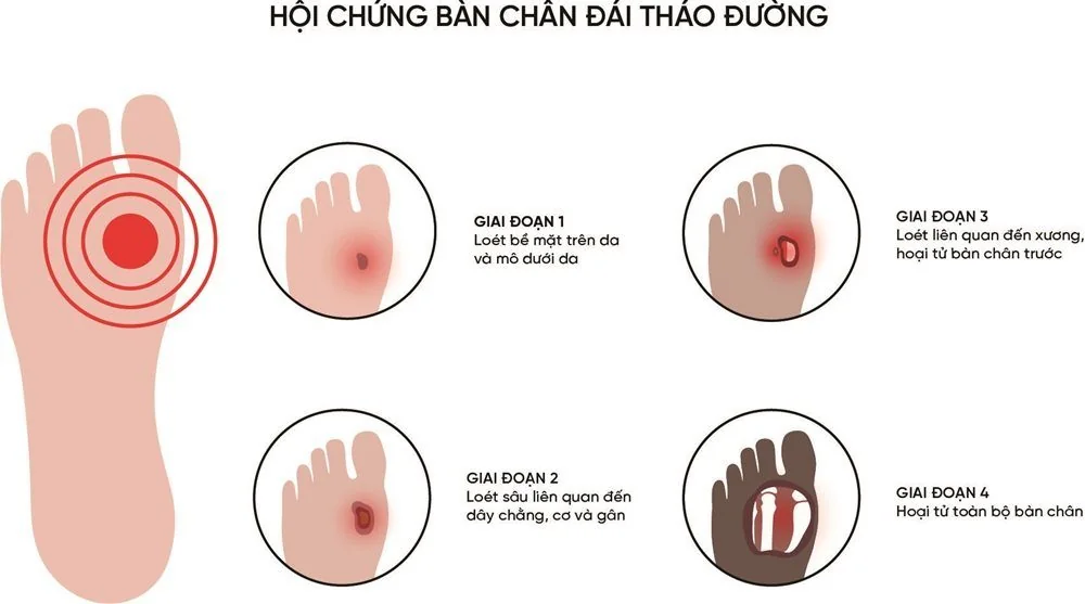 Bệnh viện Sante - Bệnh bàn chân đái tháo đường (Hình 2)