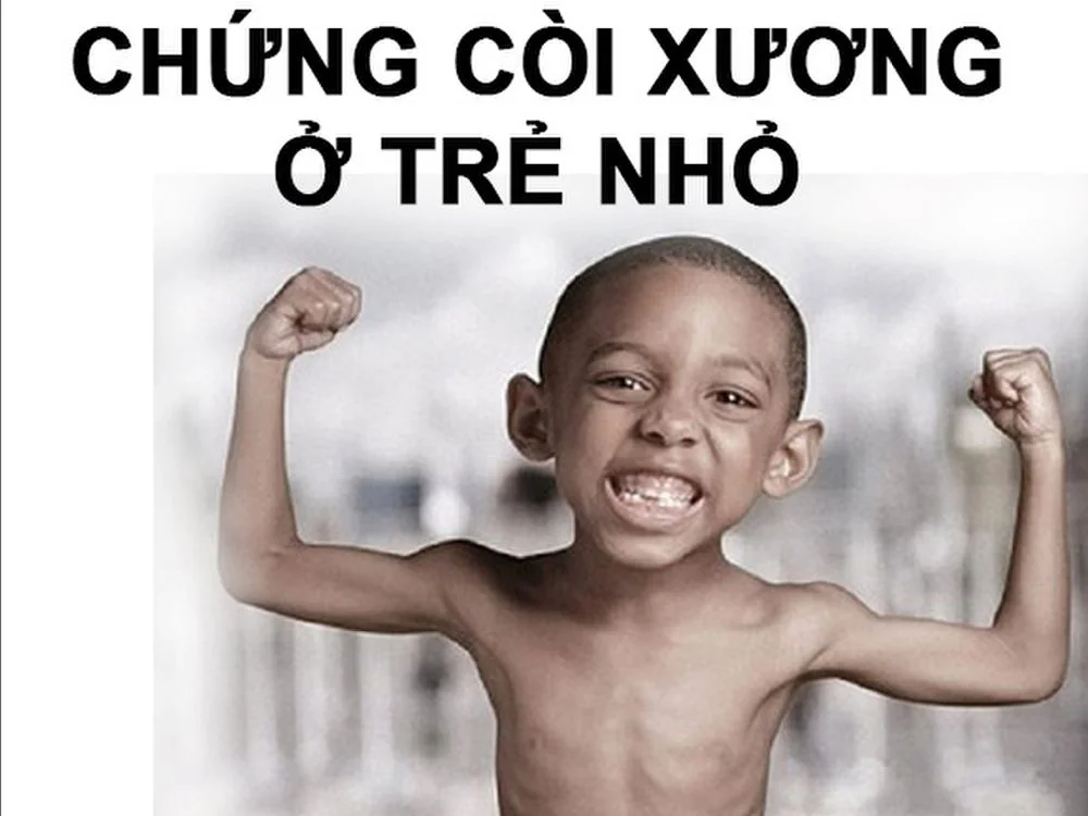 Bệnh viện Sante - Còi xương là bệnh như thế nào? Triệu chứng và cách chẩn đoán