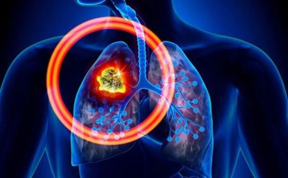 Bệnh viện Sante - Các loại ung thư phổi_ nhận biết_ cách phòng tránh hiệu quả