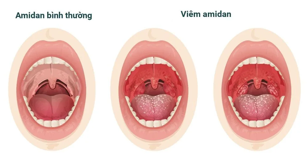 산테병원 - 인후통을 유발하는 원인은 무엇인가? 증상_ 치료법 (이미지 4) 산테병원 - 인후통을 유발하는 원인은 무엇인가? 증상_ 치료법 (이미지 4)