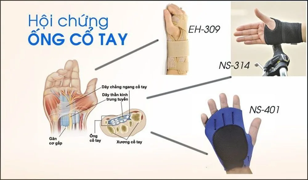 Bệnh viện Sante - Hội chứng ống cổ tay (Hình 3) Bệnh viện Sante - Hội chứng ống cổ tay (Hình 3)