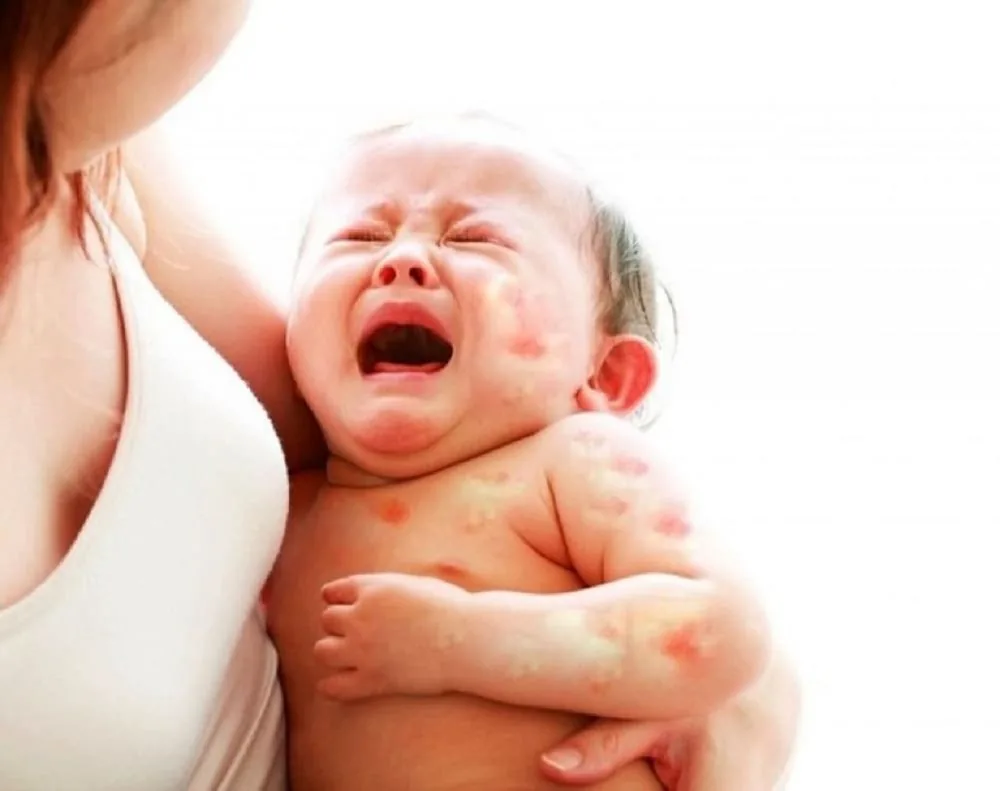 Bệnh viện Sante - Viêm da dị ứng ở trẻ: Nguyên nhân_ triệu chứng và cách điều trị (Hình 2)