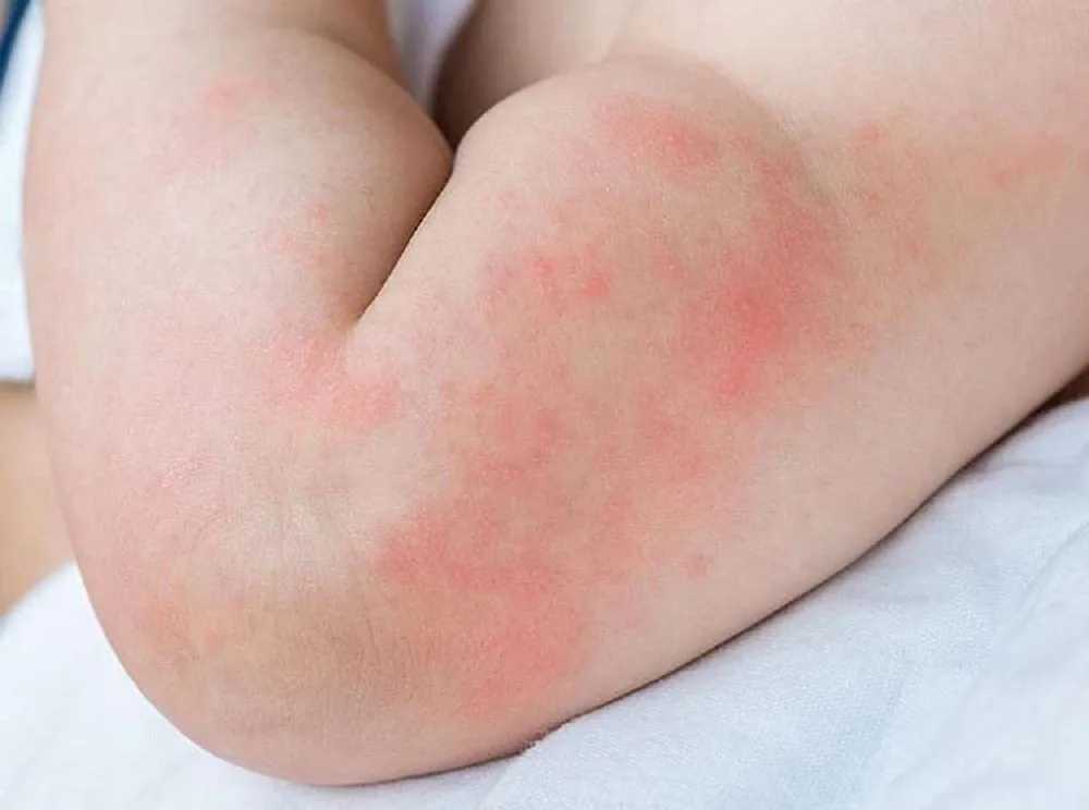 Bệnh viện Sante - Cách chăm sóc đúng tình trạng nổi mề đay ở trẻ nhỏ mẹ nên biết (Hình 2)