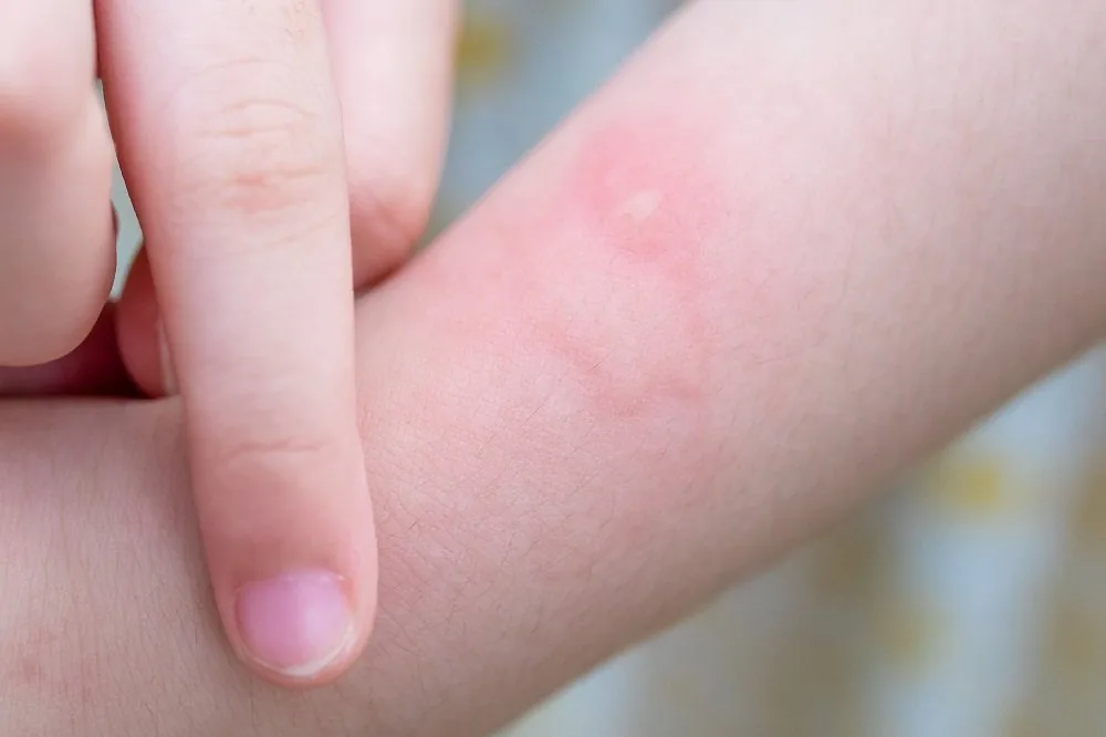 Bệnh viện Sante - Cách chăm sóc đúng tình trạng nổi mề đay ở trẻ nhỏ mẹ nên biết (Hình 3)