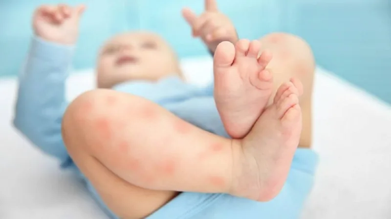 Bệnh viện Sante - Cách chăm sóc đúng tình trạng nổi mề đay ở trẻ nhỏ mẹ nên biết