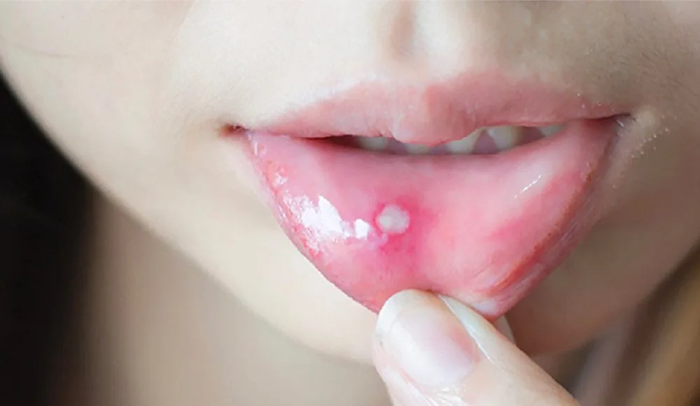 Bệnh viện Sante - Nhiệt miệng có nguy hiểm không? (Hình 2)