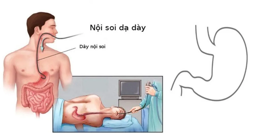 Bệnh viện Sante - Những điều cần biết về viêm loét dạ dày (Hình 3)