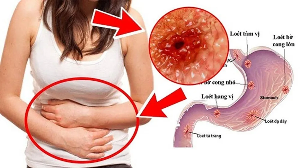 Bệnh viện Sante - Những điều cần biết về viêm loét dạ dày (Hình 2)