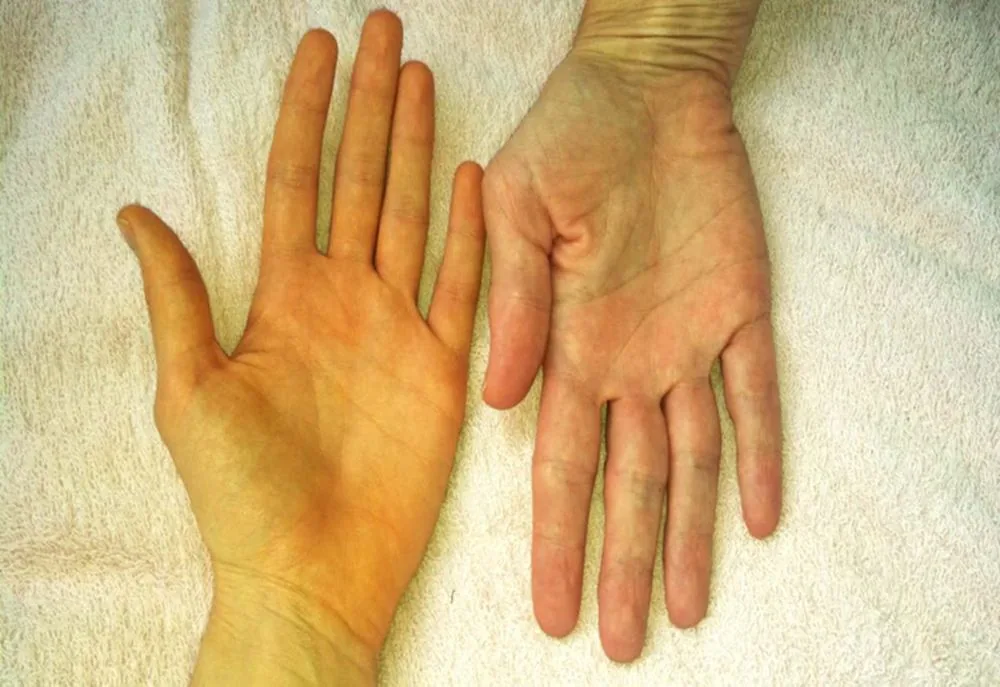 Bệnh viện Sante - Triệu chứng ung thư gan_ nguyên nhân_ đối tượng dễ mắc bệnh (Hình 2) Bệnh viện Sante - Triệu chứng ung thư gan_ nguyên nhân_ đối tượng dễ mắc bệnh (Hình 2)