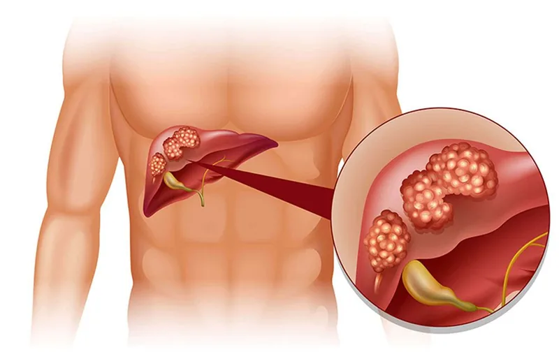Bệnh viện Sante - Triệu chứng ung thư gan_ nguyên nhân_ đối tượng dễ mắc bệnh Bệnh viện Sante - Triệu chứng ung thư gan_ nguyên nhân_ đối tượng dễ mắc bệnh