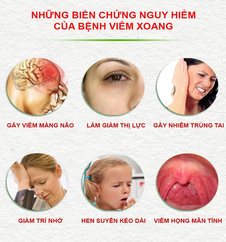 Bệnh viện Sante - Viêm mũi xoang và những nguy hiểm khôn lường (Hình 3) Bệnh viện Sante - Viêm mũi xoang và những nguy hiểm khôn lường (Hình 3)
