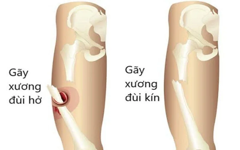 gãy xượng đùi gãy xượng đùi - Bệnh viện SANTE Bình Thạnh, TP.HCM