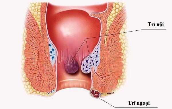 Tìm hiểu về bệnh trĩ: Nguyên nhân – dấu hiệu – cách điều trị