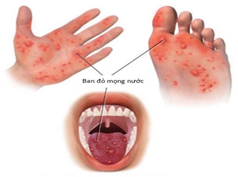 Bệnh tay chân miệng ở trẻ và những biến chứng nguy hiểm