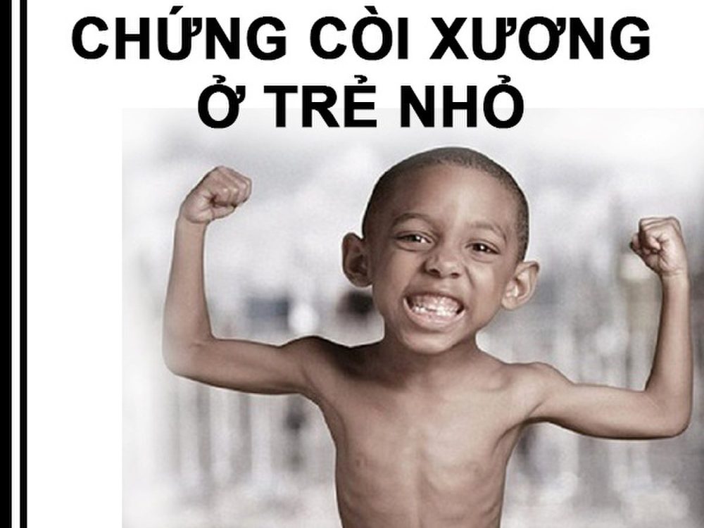 Còi xương là bệnh như thế nào? Triệu chứng và cách chẩn đoán