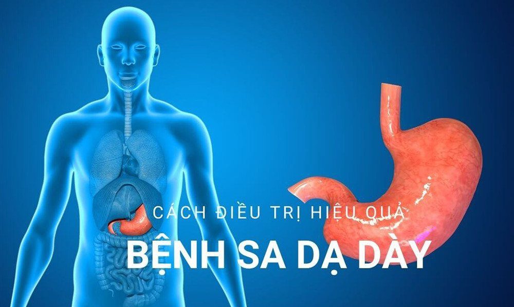 Sa dạ dày - Nguyên nhân triệu chứng và cách điều trị