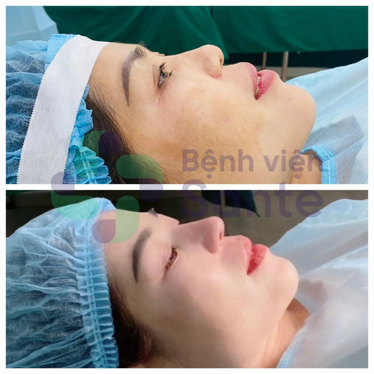 Phẫu thuật nâng mũi là gì? Bệnh viện chuyên khoa phẫu thuật nâng mũi chất lượng quốc tế HCM