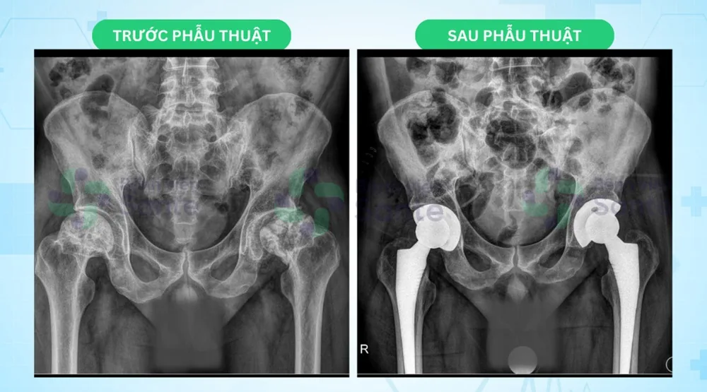 Quay lại thay khớp háng thứ 2 sau 1 tháng - Hình 2 - Bệnh viện SANTE Bình Thạnh, TP.HCM