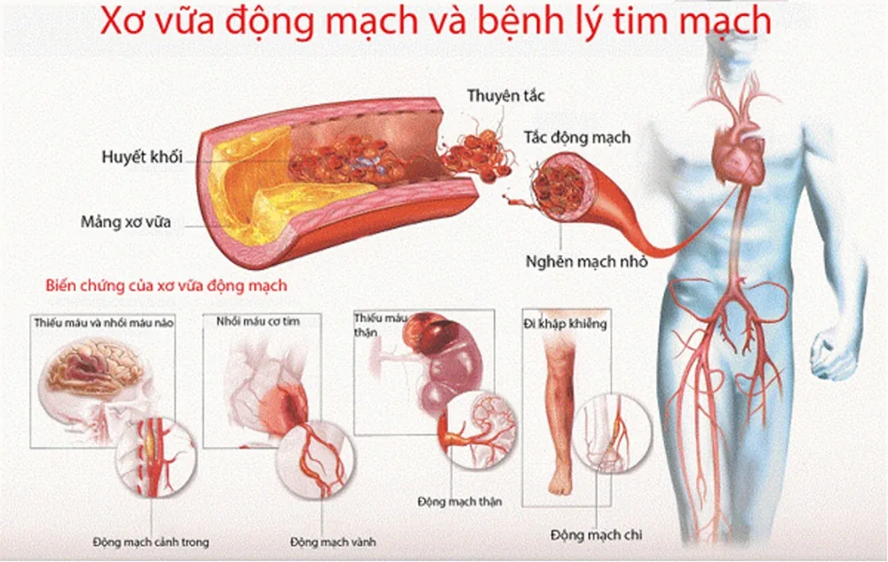 Rối loạn Lipid máu và nguy cơ bệnh tim mạch - Hình 2 - Bệnh viện SANTE Bình Thạnh, TP.HCM