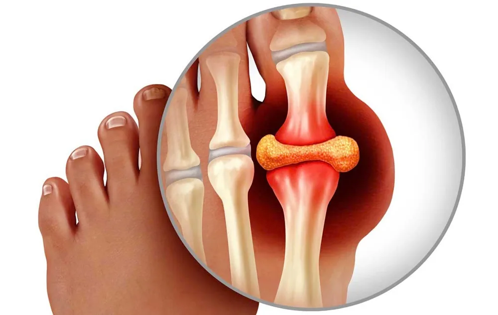 Từ đau nhức đến mất khả năng vận động - Hậu quả của việc lơ là điều trị Gout - Hình 2 - Bệnh viện SANTE Bình Thạnh, TP.HCM