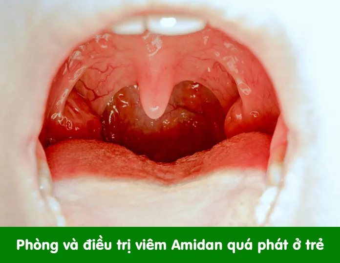 VIÊM AMIDAN QUÁ PHÁT - Hình 2 - Bệnh viện SANTE Bình Thạnh, TP.HCM