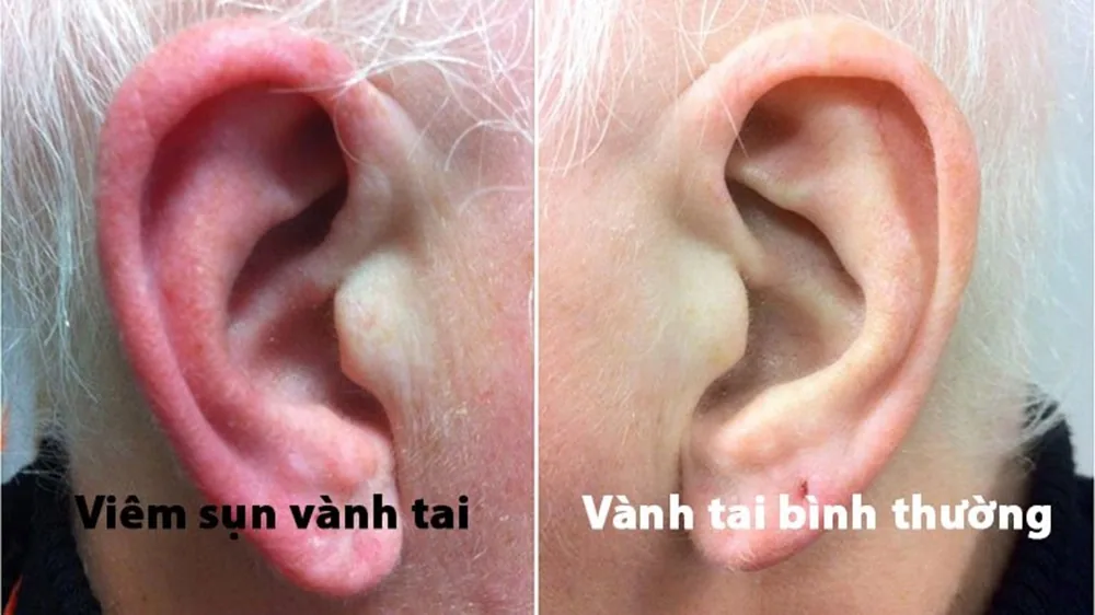 Viêm sụn vành tai và những điều cần biết - Hình 2 - Bệnh viện SANTE Bình Thạnh, TP.HCM