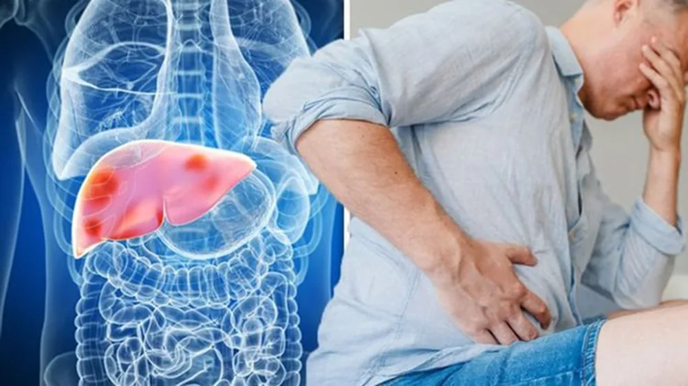 Dấu hiệu nhận biết xơ gan và ung thư gan 2 Dấu hiệu nhận biết xơ gan và ung thư gan 2 - Bệnh viện SANTE Bình Thạnh, TP.HCM