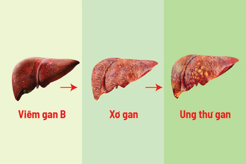 Dấu hiệu nhận biết xơ gan và ung thư gan Dấu hiệu nhận biết xơ gan và ung thư gan - Bệnh viện SANTE Bình Thạnh, TP.HCM