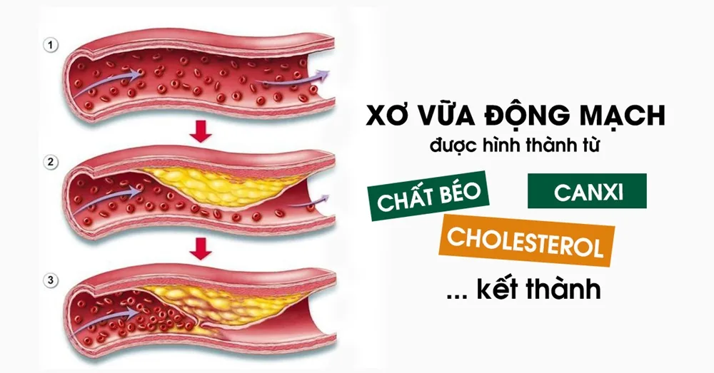 Xơ vữa động mạch - nguy cơ gây tử vong thầm lặng - Hình 2 - Bệnh viện SANTE Bình Thạnh, TP.HCM
