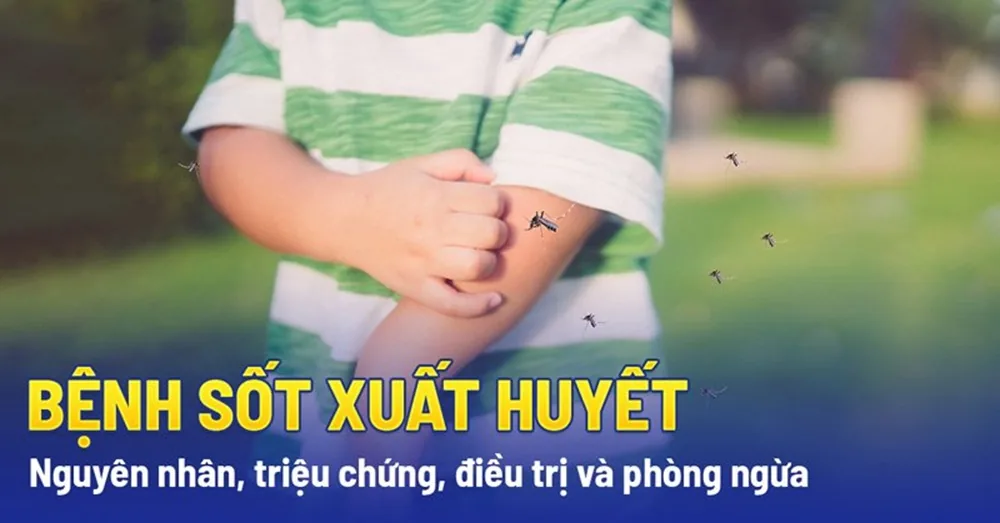 Những điều cần biết về sốt xuất huyết - Hình 2 - Bệnh viện SANTE Bình Thạnh, TP.HCM
